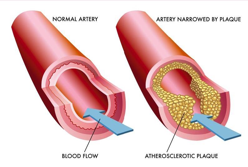 Comparison image showing healthy blood vessels versus blood vessels affected by excess weight and fat deposits